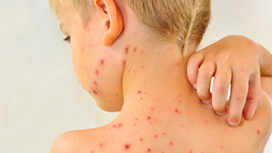 الصحة المغربية : حالات جديدة من ” بوحمرون ” تغزو البلاد وعلى الجميع الحذر