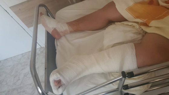 مهاجر مغربي يتعرض لعضة ” قرش ” بشاطئ القرية بالناظور