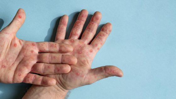 جدري القردة و حالة الطوارئ العامة