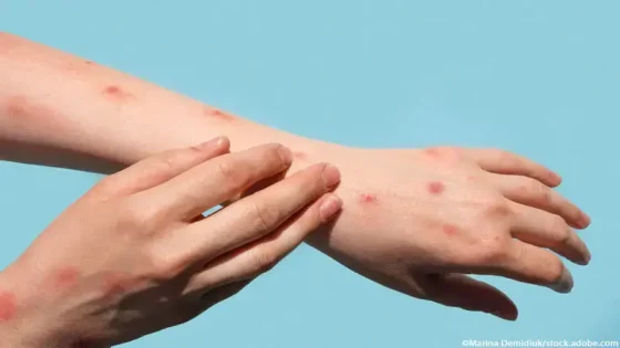 وزارة الصحة تسجل حالة مرض جدري القردة بالمغرب