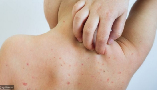 الحصبة تعود بقوة في المغرب: أرقام مقلقة وخطة طوارئ وطنية