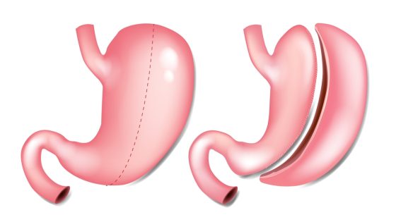 أطباء بمستشفى أنتويرب يبتكرون طريقة عبقرية لتصغير ” المعدة “